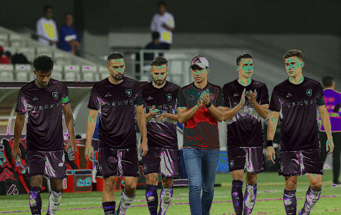 Tòa án Islamabad buộc PESCO chi trả cho bé gái chín tuổi mất hai tay vì điện giật